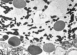 M,60y. | fibrinous pneumonia